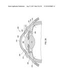 Intraocular implant delivery apparatus and methods of use thereof diagram and image