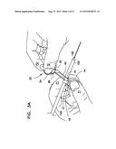 DEVICE FOR PREPARING AN IMPLANTED MEDICAL APPARATUS FOR EXTRACTION diagram and image