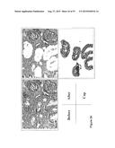 USE OF METHYLATED OR UNMETHYLATED LINE-1 DNA AS A CANCER MARKER diagram and image