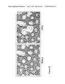 USE OF METHYLATED OR UNMETHYLATED LINE-1 DNA AS A CANCER MARKER diagram and image