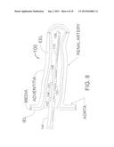 TRANSVASCULAR METHOD OF TREATING HYPERTENSION diagram and image