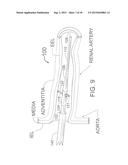 TRANSVASCULAR METHOD OF TREATING HYPERTENSION diagram and image