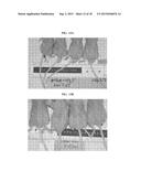 EXTRACELLULAR MATRIX COMPOSITIONS FOR THE TREATMENT OF CANCER diagram and image