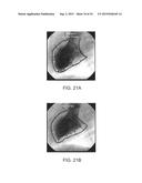 CARTRIDGE AND METHOD FOR INCREASING MYOCARDIAL FUNCTION diagram and image
