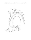 Guide for intravascular device diagram and image