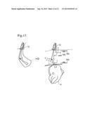 DEVICE AND METHOD FOR DEBONING BONE-IN LEG diagram and image