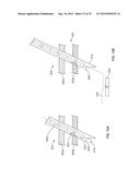 SUTURE ANCHORING SYSTEM AND DELIVERY METHOD diagram and image