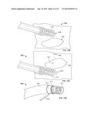 SUTURE ANCHORING SYSTEM AND DELIVERY METHOD diagram and image