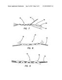 ALL-SUTURE SUTURE ANCHOR SYSTEMS AND METHODS diagram and image