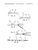 ALL-SUTURE SUTURE ANCHOR SYSTEMS AND METHODS diagram and image