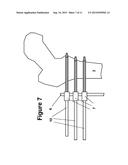 Method and Apparatus for Minimally Invasive Subcutaneous Treatment of Long     Bone Fractures diagram and image