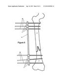 Method and Apparatus for Minimally Invasive Subcutaneous Treatment of Long     Bone Fractures diagram and image