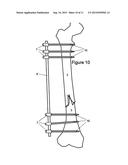 Method and Apparatus for Minimally Invasive Subcutaneous Treatment of Long     Bone Fractures diagram and image