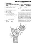 METHOD FOR FIXATION OF BONE FRAGMENTS AT BONE FRACTURES diagram and image