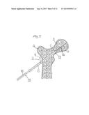 METHOD FOR FIXATION OF BONE FRAGMENTS AT BONE FRACTURES diagram and image