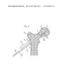 METHOD FOR FIXATION OF BONE FRAGMENTS AT BONE FRACTURES diagram and image