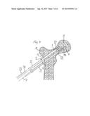 METHOD FOR FIXATION OF BONE FRAGMENTS AT BONE FRACTURES diagram and image