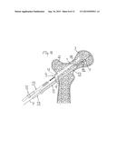 METHOD FOR FIXATION OF BONE FRAGMENTS AT BONE FRACTURES diagram and image