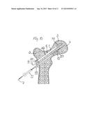 METHOD FOR FIXATION OF BONE FRAGMENTS AT BONE FRACTURES diagram and image