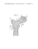 METHOD FOR FIXATION OF BONE FRAGMENTS AT BONE FRACTURES diagram and image