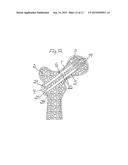 METHOD FOR FIXATION OF BONE FRAGMENTS AT BONE FRACTURES diagram and image