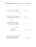 METHOD FOR TREATING VARICOSE VEINS AND INTRALUMINAL DEVICE USED IN SUCH     METHOD diagram and image