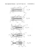 METHOD FOR TREATING VARICOSE VEINS AND INTRALUMINAL DEVICE USED IN SUCH     METHOD diagram and image