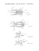 METHOD FOR TREATING VARICOSE VEINS AND INTRALUMINAL DEVICE USED IN SUCH     METHOD diagram and image