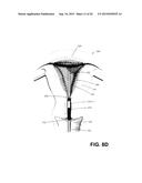 SYSTEM AND METHOD FOR ENDOMETRIAL ABLATION diagram and image