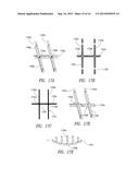 MEDICAL DEVICE FOR USE IN BODILY LUMENS, FOR EXAMPLE AN ATRIUM diagram and image