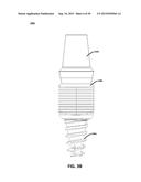 ECCENTRIC DENTAL IMPLANT SYSTEM diagram and image