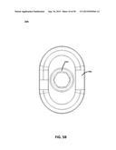 ECCENTRIC DENTAL IMPLANT SYSTEM diagram and image