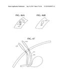 SELF-ANCHORING SLING AND INTRODUCER SYSTEM diagram and image