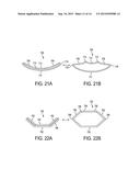 BISTABLE SPRING CONSTRUCTION FOR A STENT AND OTHER MEDICAL APPARATUS diagram and image