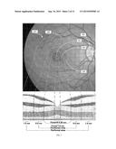 INTRAOCULAR LENS THAT IMPROVES OVERALL VISION WHERE THERE IS A LOCAL LOSS     OF RETINAL FUNCTION diagram and image