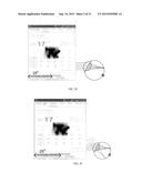 INTRAOCULAR LENS THAT IMPROVES OVERALL VISION WHERE THERE IS A LOCAL LOSS     OF RETINAL FUNCTION diagram and image