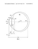 ENHANCED TORIC LENS THAT IMPROVES OVERALL VISION WHERE THERE IS A LOCAL     LOSS OF RETINAL FUNCTION diagram and image