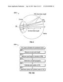 ENHANCED TORIC LENS THAT IMPROVES OVERALL VISION WHERE THERE IS A LOCAL     LOSS OF RETINAL FUNCTION diagram and image