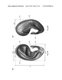 AURICULAR IMPLANT diagram and image