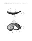 AURICULAR IMPLANT diagram and image