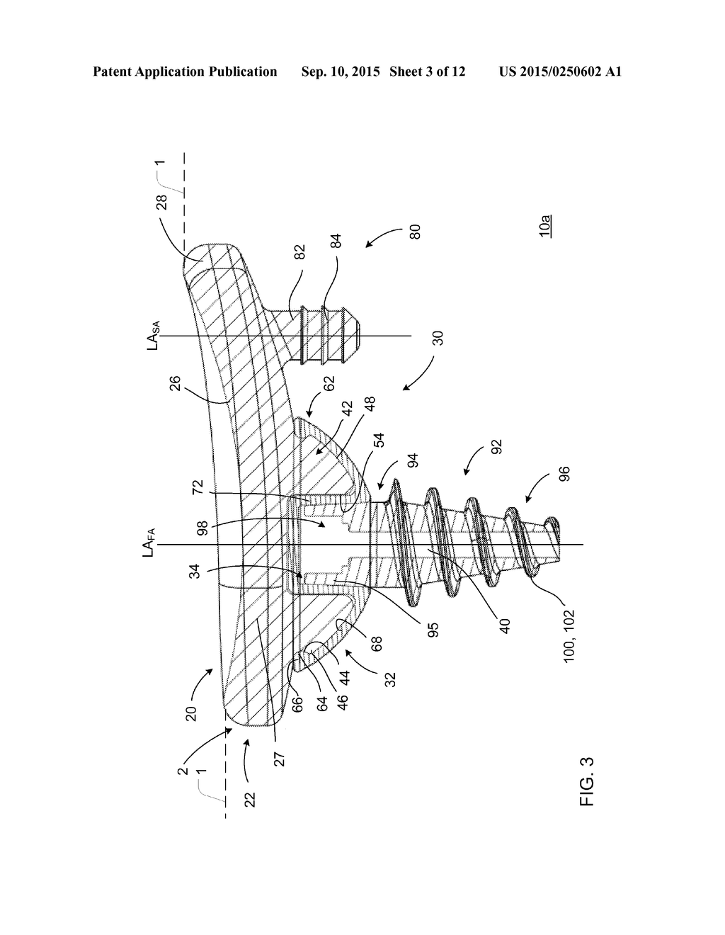 IMPLANT AND ANCHOR ASSEMBLY - diagram, schematic, and image 04