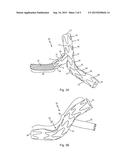 VASCULAR IMPLANT WITH SIDE BRANCH diagram and image