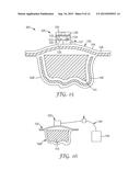 WOUND DRESSING WITH MICROPUMP diagram and image