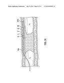 Catheter Assemblies and Methods for Stabilizing a Catheter Assembly Within     a Subintimal Space diagram and image