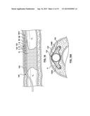 Catheter Assemblies and Methods for Stabilizing a Catheter Assembly Within     a Subintimal Space diagram and image