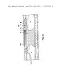 Catheter Assemblies and Methods for Stabilizing a Catheter Assembly Within     a Subintimal Space diagram and image