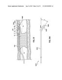 Catheter Assemblies and Methods for Stabilizing a Catheter Assembly Within     a Subintimal Space diagram and image