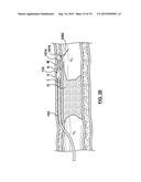 Catheter Assemblies and Methods for Stabilizing a Catheter Assembly Within     a Subintimal Space diagram and image