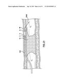 Catheter Assemblies and Methods for Stabilizing a Catheter Assembly Within     a Subintimal Space diagram and image