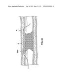 Catheter Assemblies and Methods for Stabilizing a Catheter Assembly Within     a Subintimal Space diagram and image